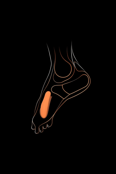 Revolutionizing CLI Treatment: Insights from VesCell HealthTalks #10